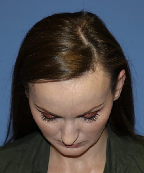 Rhinoplasty #6562 – click HERE for more views before photo. Individual results may vary.