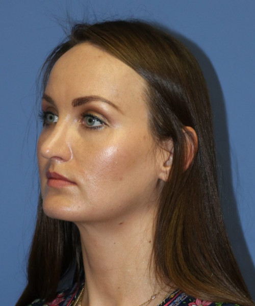 Rhinoplasty #6562 – click HERE for more views after photo. Individual results may vary.