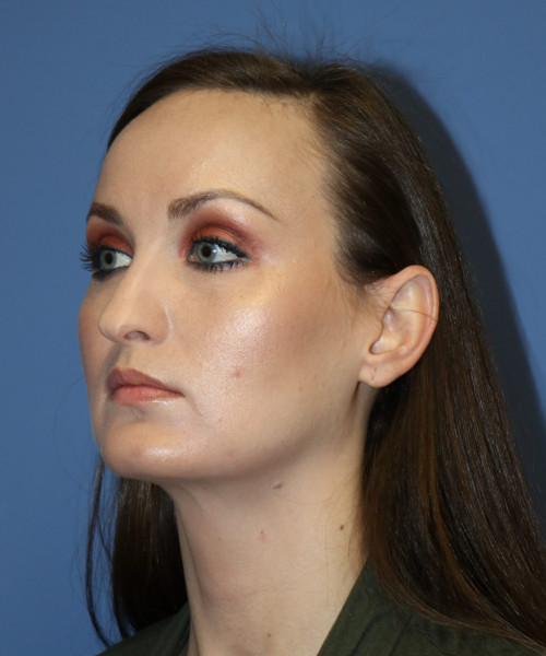 Rhinoplasty #6562 – click HERE for more views before photo. Individual results may vary.