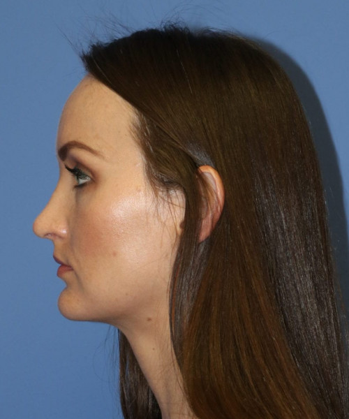 Rhinoplasty #6562 – click HERE for more views after photo. Individual results may vary.