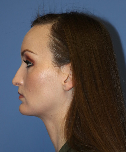 Rhinoplasty #6562 – click HERE for more views before photo. Individual results may vary.