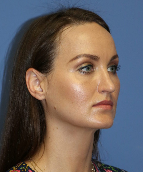 Rhinoplasty #6562 – click HERE for more views after photo. Individual results may vary.