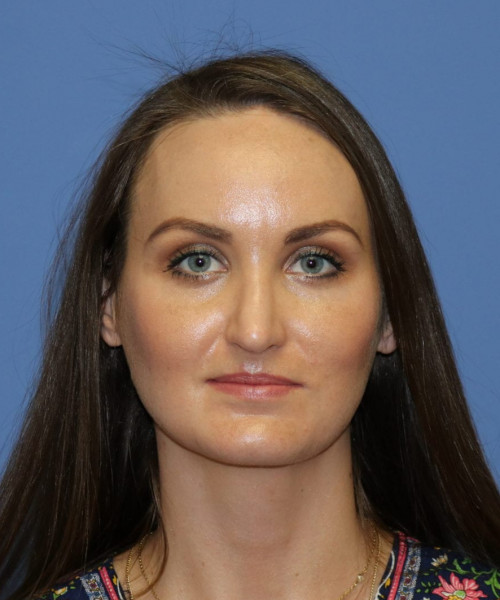 Rhinoplasty #6562 – click HERE for more views after photo. Individual results may vary.