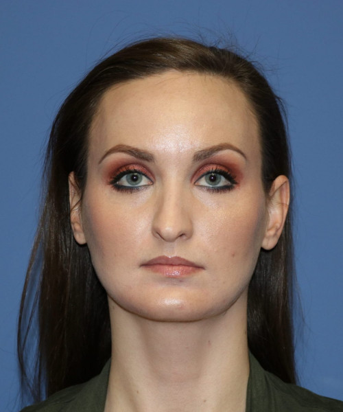 Rhinoplasty #6562 – click HERE for more views before photo. Individual results may vary.