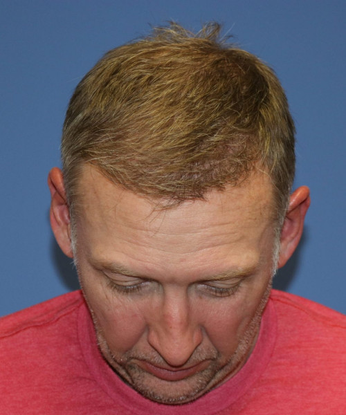 Hair Transplant #6614 – click HERE for more views after photo. Individual results may vary.