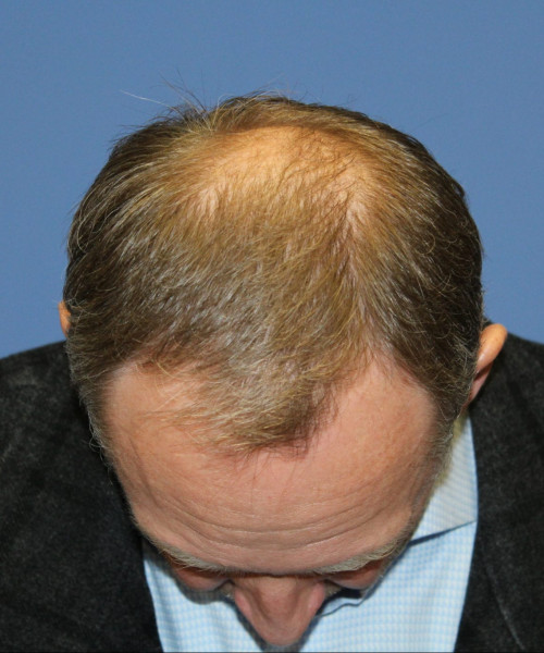 Hair Transplant #6614 – click HERE for more views before photo. Individual results may vary.