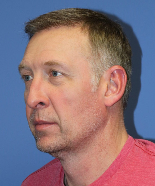 Hair Transplant #6614 – click HERE for more views after photo. Individual results may vary.