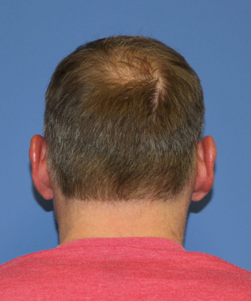 Hair Transplant #6614 – click HERE for more views after photo. Individual results may vary.