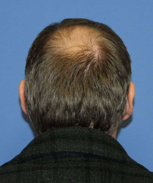 Hair Transplant #6614 – click HERE for more views before photo. Individual results may vary.