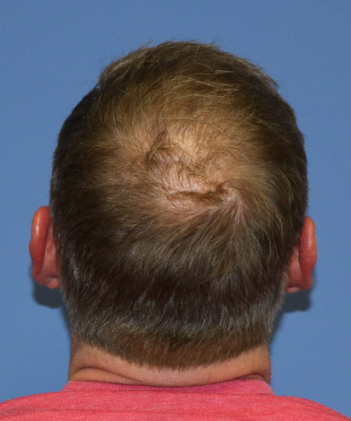 Hair Transplant #6614 – click HERE for more views after photo. Individual results may vary.