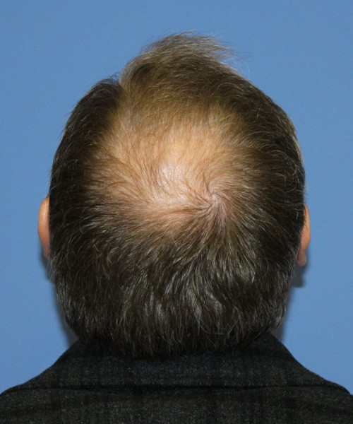 Hair Transplant #6614 – click HERE for more views before photo. Individual results may vary.