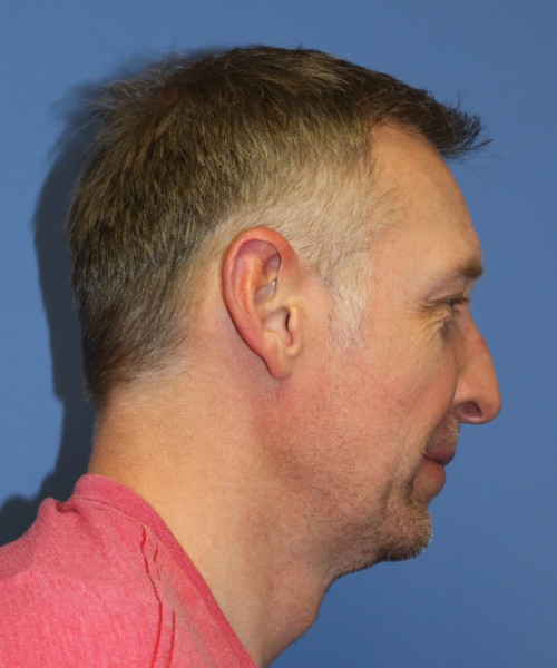 Hair Transplant #6614 – click HERE for more views after photo. Individual results may vary.