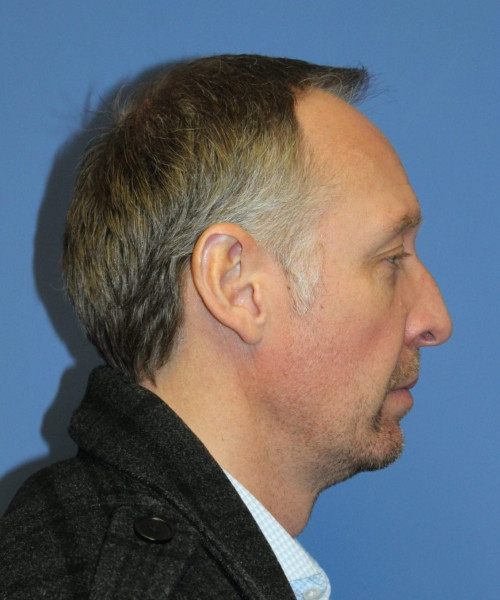 Hair Transplant #6614 – click HERE for more views before photo. Individual results may vary.