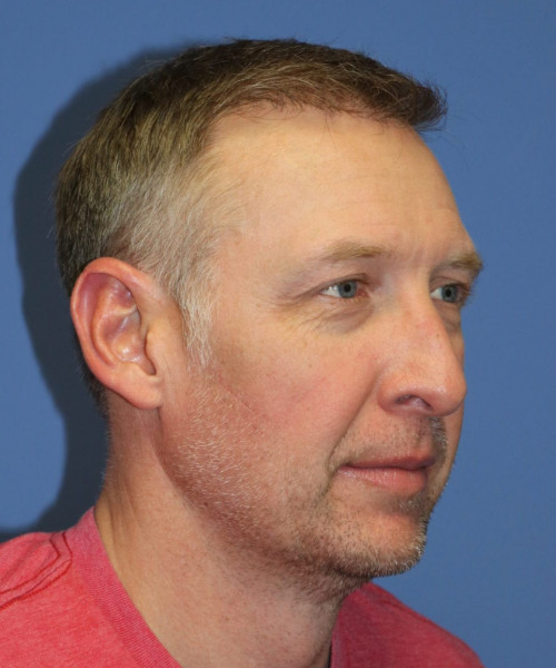 Hair Transplant #6614 – click HERE for more views after photo. Individual results may vary.