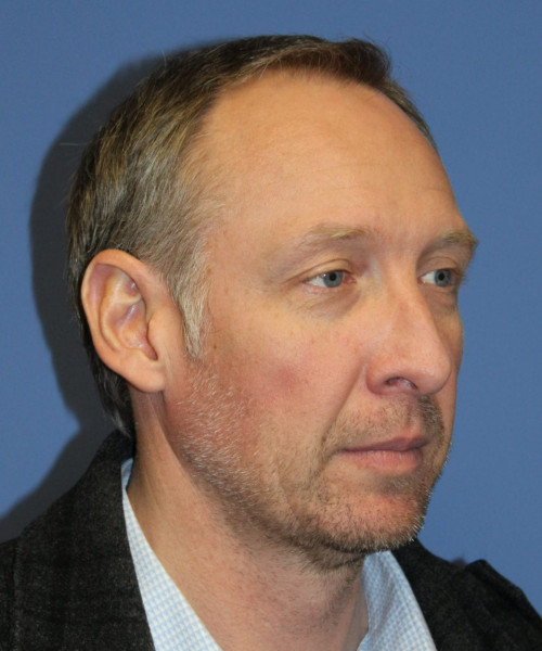 Hair Transplant #6614 – click HERE for more views before photo. Individual results may vary.