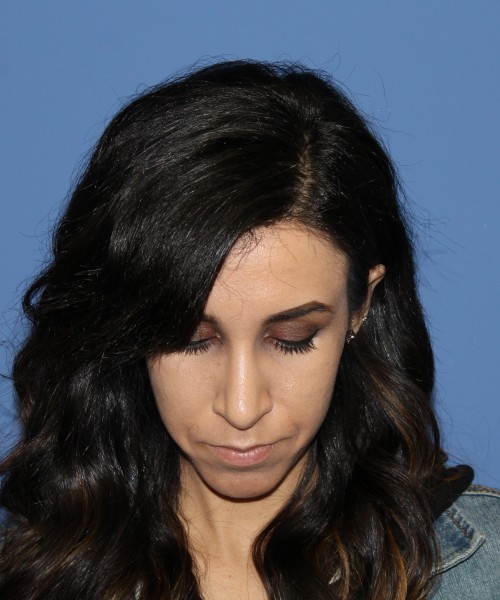 Rhinoplasty 0666 – Click HERE for more views after photo. Individual results may vary.