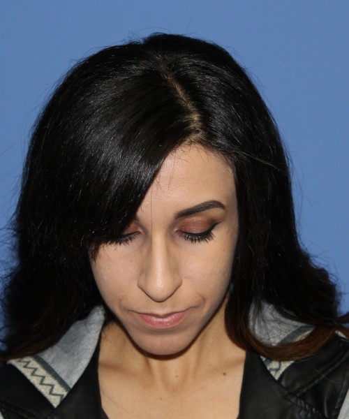 Rhinoplasty 0666 – Click HERE for more views before photo. Individual results may vary.