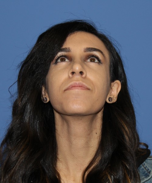 Rhinoplasty 0666 – Click HERE for more views after photo. Individual results may vary.