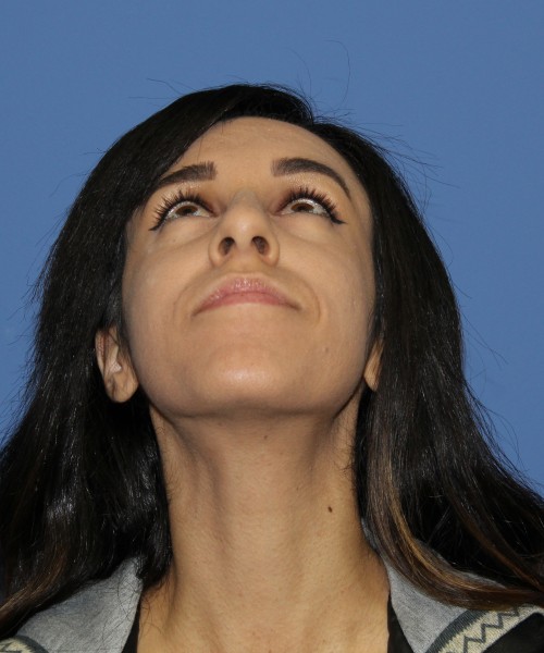 Rhinoplasty 0666 – Click HERE for more views before photo. Individual results may vary.