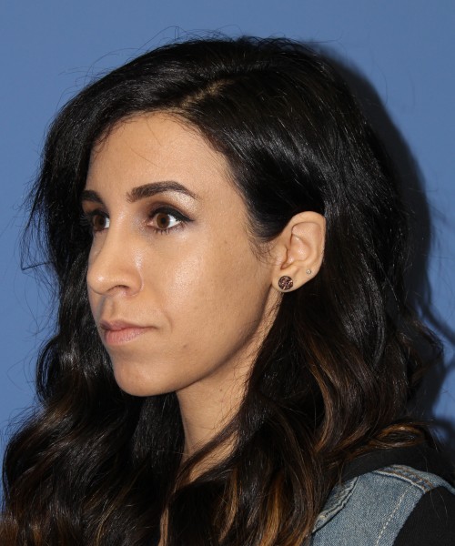 Rhinoplasty 0666 – Click HERE for more views after photo. Individual results may vary.