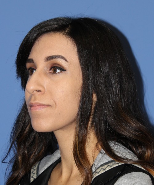 Rhinoplasty 0666 – Click HERE for more views before photo. Individual results may vary.