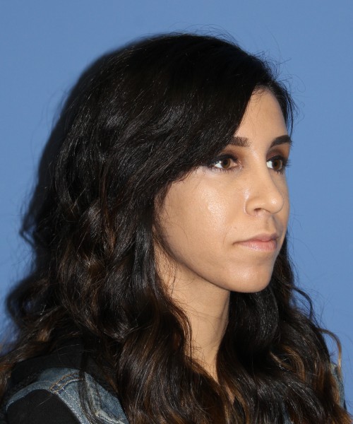 Rhinoplasty 0666 – Click HERE for more views after photo. Individual results may vary.