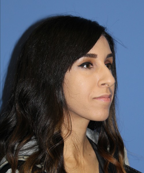 Rhinoplasty 0666 – Click HERE for more views before photo. Individual results may vary.