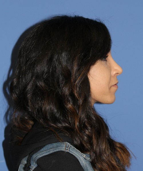 Rhinoplasty 0666 – Click HERE for more views after photo. Individual results may vary.