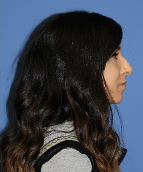 Rhinoplasty 0666 – Click HERE for more views before photo. Individual results may vary.