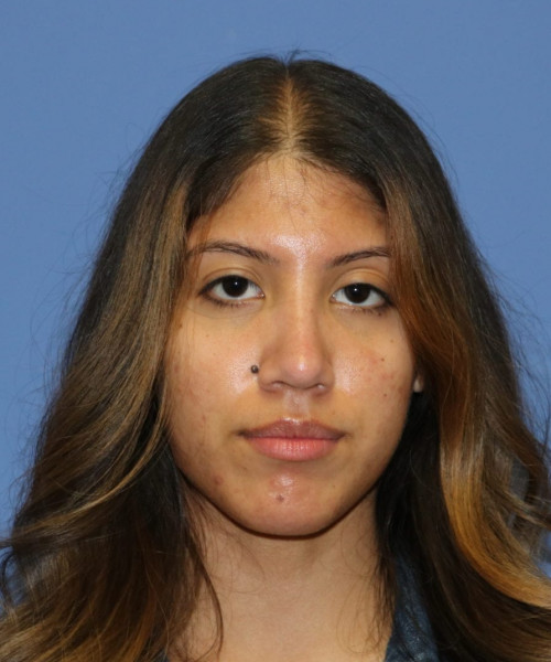 Rhinoplasty #6786 – click HERE for more views after photo. Individual results may vary.