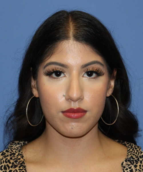Rhinoplasty #6786 – click HERE for more views before photo. Individual results may vary.