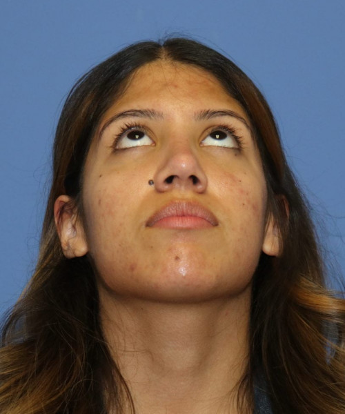 Rhinoplasty #6786 – click HERE for more views after photo. Individual results may vary.