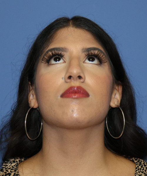 Rhinoplasty #6786 – click HERE for more views before photo. Individual results may vary.