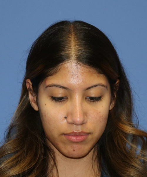 Rhinoplasty #6786 – click HERE for more views after photo. Individual results may vary.