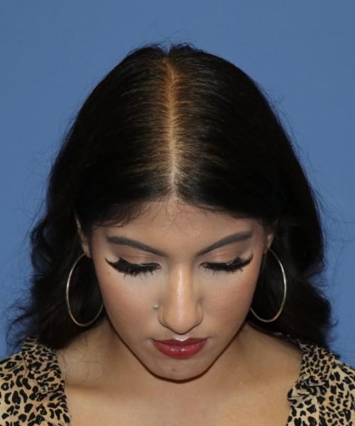 Rhinoplasty #6786 – click HERE for more views before photo. Individual results may vary.