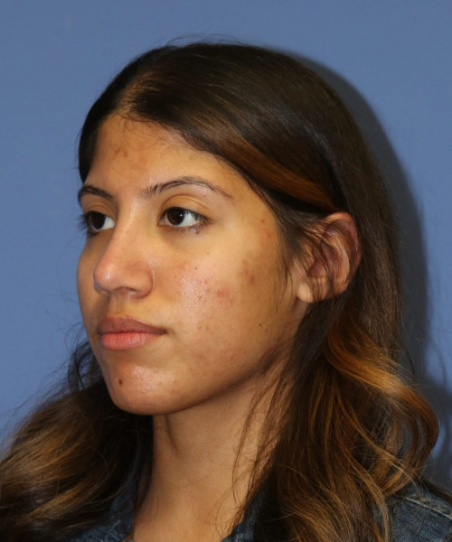 Rhinoplasty #6786 – click HERE for more views after photo. Individual results may vary.