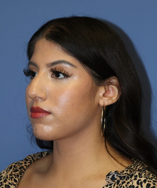 Rhinoplasty #6786 – click HERE for more views before photo. Individual results may vary.