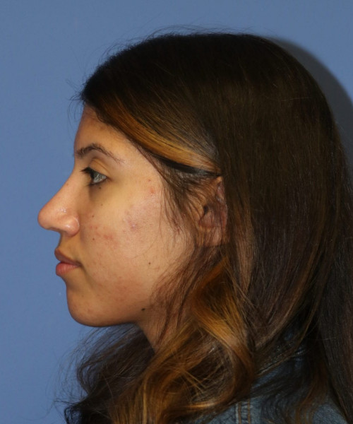 Rhinoplasty #6786 – click HERE for more views after photo. Individual results may vary.