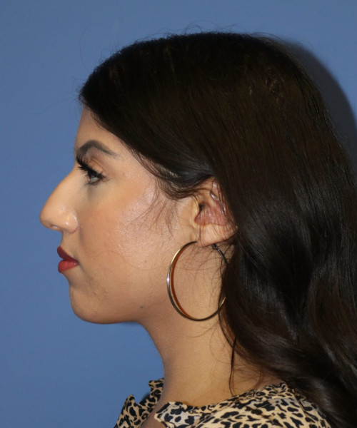 Rhinoplasty #6786 – click HERE for more views before photo. Individual results may vary.