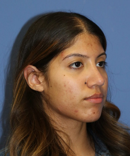 Rhinoplasty #6786 – click HERE for more views after photo. Individual results may vary.