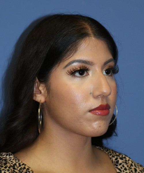 Rhinoplasty #6786 – click HERE for more views before photo. Individual results may vary.