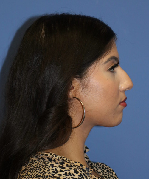 Rhinoplasty #6786 – click HERE for more views before photo. Individual results may vary.