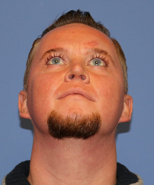 Rhinoplasty #6818 – click HERE for more views after photo. Individual results may vary.