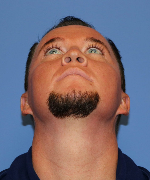 Rhinoplasty #6818 – click HERE for more views before photo. Individual results may vary.