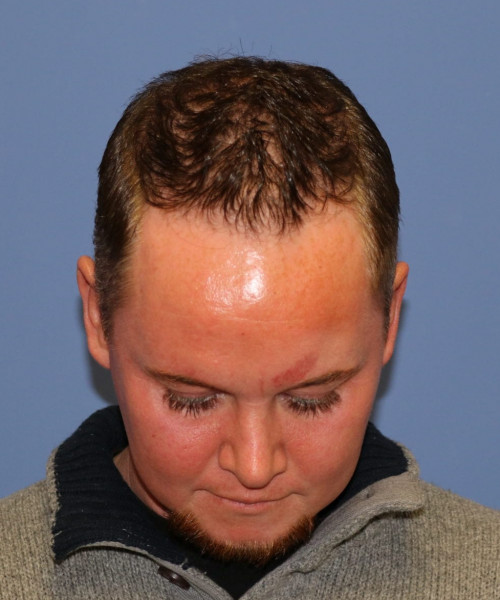 Rhinoplasty #6818 – click HERE for more views after photo. Individual results may vary.