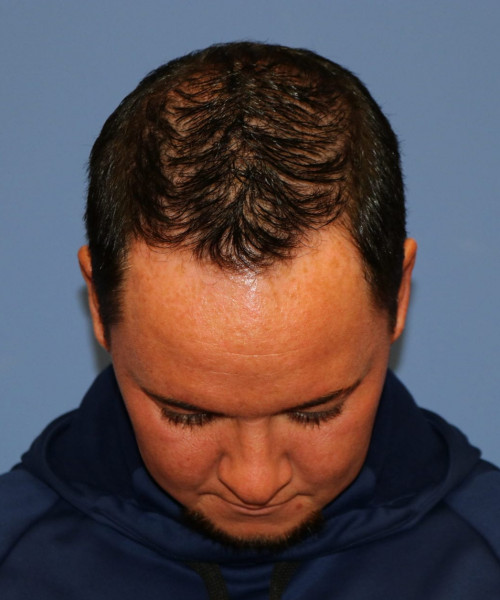 Rhinoplasty #6818 – click HERE for more views before photo. Individual results may vary.