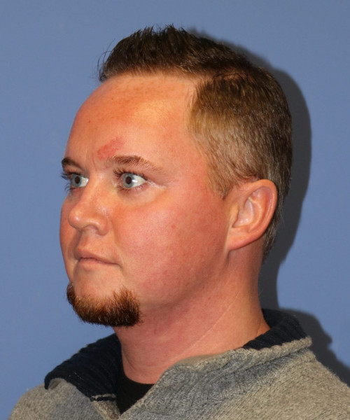 Rhinoplasty #6818 – click HERE for more views after photo. Individual results may vary.