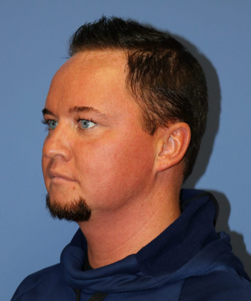 Rhinoplasty #6818 – click HERE for more views before photo. Individual results may vary.