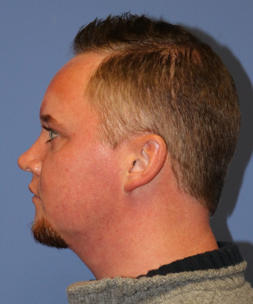 Rhinoplasty #6818 – click HERE for more views after photo. Individual results may vary.