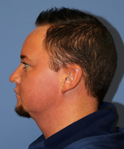 Rhinoplasty #6818 – click HERE for more views before photo. Individual results may vary.